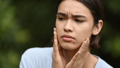 Hormonal Acne Can Happen at Any Age. Here’s How to Deal