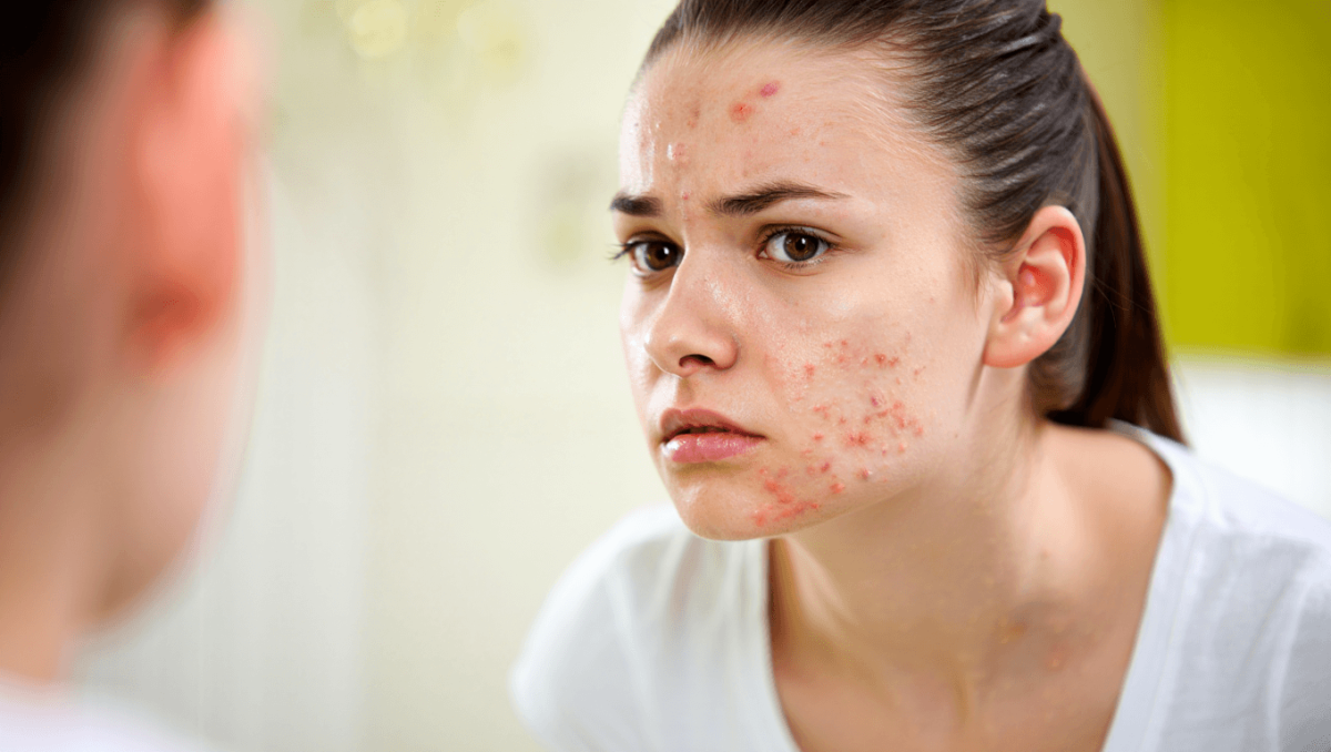 Solutions for the Most Common Types of Acne, According to Dermatologists
