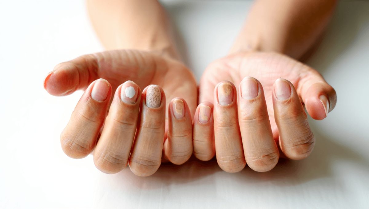 What These 8 Fingernail Signs Say About Your Health
