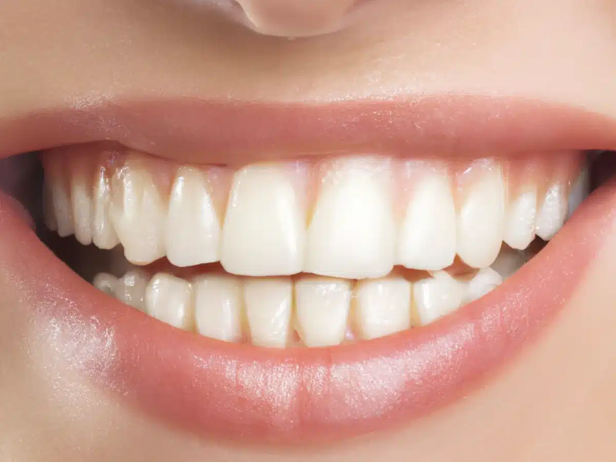 Vue microscopique de l'émail dentaire montrant les dégâts causés par l'abrasion d'un dentifrice